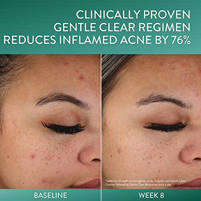 Cetaphil Acne Face Wash